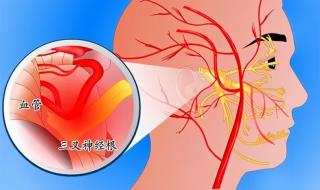  三叉神经痛哪个医院治疗好